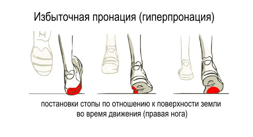 ГИПЕРПРОНАЦИЯ