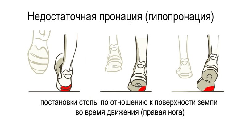 ГИПОПРОНАЦИЯ